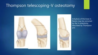 Thompson telescoping-V osteotomy
Ankylosis of the knee in
flexion may be corrected
by the V-osteotomy
described by Thompson
pos
 