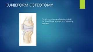 CUNIEFORM OSTEOTOMY
Cuneiform osteotomy based anteriorly.
Section of bone removed is indicated by
blue area
 