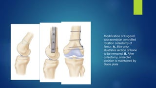Modification of Osgood
supracondylar controlled
rotation osteotomy of
femur. A, Blue area
illustrates section of bone
to be removed. B, After
osteotomy, corrected
position is maintained by
blade plate
 