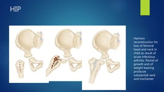 HIP
Harmon
reconstruction for
loss of femoral
head and neck in
child as result of
acute infectious
arthritis. Period of
growth and of
weight bearing
produces
substantial neck
and trochanter
 
