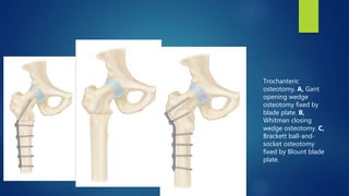 Trochanteric
osteotomy. A, Gant
opening wedge
osteotomy fixed by
blade plate. B,
Whitman closing
wedge osteotomy. C,
Brackett ball-and-
socket osteotomy
fixed by Blount blade
plate.
 