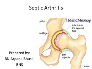 Septic Arthritis
Prepared by:
RN Arpana Bhusal
BNS
 