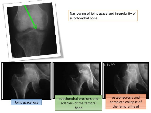 Septic arthritis