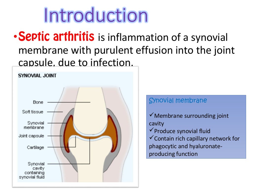 Septic arthritis