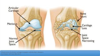 Ultrastructure of articular cartilage in pyogenic arthritis.Roy S, Bhawan J
Arch Pathol. 1975 Jan; 99(1):44-7.
 