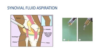 SYNOVIAL FLUID ASPIRATION
 