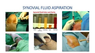 SYNOVIAL FLUID ASPIRATION
 