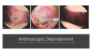 Arthroscopic Debridement
 