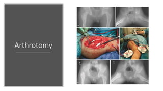 Arthrotomy
 