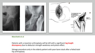 Marchetti et al
Patients with a resection arthroplasty will be left with a significant leg length
discrepancy due to abductor strength weakness and piston effect.
Salvage procedure only in the elderly patient with poor bone stock after a failed total
hip arthroplasty
 