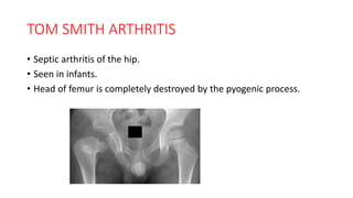 TOM SMITH ARTHRITIS
• Septic arthritis of the hip.
• Seen in infants.
• Head of femur is completely destroyed by the pyogenic process.
 