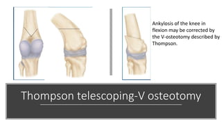 Thompson telescoping-V osteotomy
Ankylosis of the knee in
flexion may be corrected by
the V-osteotomy described by
Thompson.
 