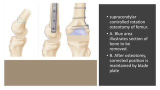 • supracondylar
controlled rotation
osteotomy of femur.
• A. Blue area
illustrates section of
bone to be
removed.
• B. After osteotomy,
corrected position is
maintained by blade
plate
 