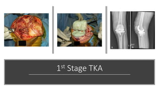 1st Stage TKA
 
