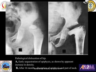 Pathological dislocation of hip.
A, Early sequestration of epiphysis, as shown by apparent
increase in density.
B, After 1...