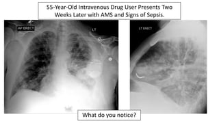 EMGuideWire's Radiology Reading Room: Septic Pulmonary Emboli | PPTX