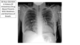 30-Year-Old With
A History Of
Intravenous Drug
Abuse Presents
With Weakness
and Shortness of
Breath.
 