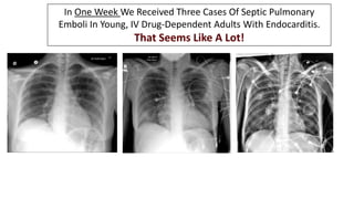 In One Week We Received Three Cases Of Septic Pulmonary
Emboli In Young, IV Drug-Dependent Adults With Endocarditis.
That ...