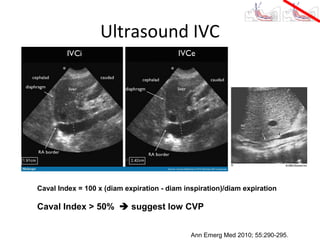 Ultrasound IVC




Caval Index = 100 x (diam expiration - diam inspiration)/diam expiration

Caval Index > 50%  suggest low CVP


                                              Ann Emerg Med 2010; 55:290-295.
 