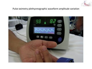 Pulse oximetry plethysmographic waveform amplitude variation
 