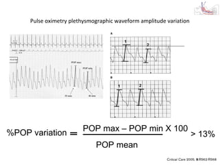 Pulse oximetry plethysmographic waveform amplitude variation




%POP variation          POP max – POP min X 100
                                                                    > 13%
                             POP mean
 
