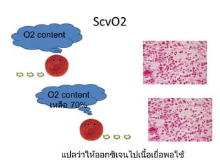 ScvO2
O2 content




     O2 content
     เหลือ 70%




         แปลว่าให้ออกซิเจนไปเนือเยือพอใช้
                               ้ ่
 