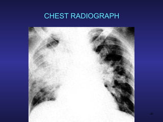 CHEST RADIOGRAPH 
