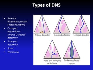Types of DNS
• Anterior
dislocation (caudal
septal deviation)
• C-shaped
deformity or
reverse C-shaped
deformity
• S-shaped
deformity
• Spurs
• Thickening
 