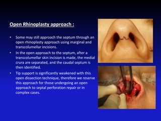 Open Rhinoplasty approach :
• Some may still approach the septum through an
open rhinoplasty approach using marginal and
transcolumellar incisions.
• In the open approach to the septum, after a
transcolumellar skin incision is made, the medial
crura are separated, and the caudal septum is
then identified.
• Tip support is significantly weakened with this
open dissection technique, therefore we reserve
this approach for those undergoing an open
approach to septal perforation repair or in
complex cases.
 