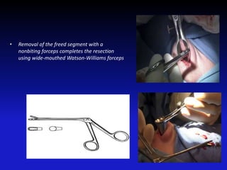 • Removal of the freed segment with a
nonbiting forceps completes the resection
using wide-mouthed Watson-Williams forceps
 