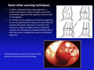 Some other suturing techniques
• A, When reapproximating septal segments, a
simple interrupted or figure-of-eight suture does
not provide support for the segments and can lead
to overlapping.
• B, A Wright suture stabilizes the fractured segments
to one mucoperichondrial flap and to each other to
maintain the proper alignment. To perform this
maneuver, a figure-of-eight suture is made that
includes the contralateral mucoperichondrial flap in
both the sutures through the superior and inferior
segments.
• Quilting mattress sutures of the septal flaps
prevent hematomas and hemorrhage.
 