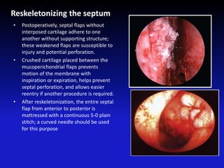 Reskeletonizing the septum
• Postoperatively, septal flaps without
interposed cartilage adhere to one
another without supporting structure;
these weakened flaps are susceptible to
injury and potential perforation.
• Crushed cartilage placed between the
mucoperichondrial flaps prevents
motion of the membrane with
inspiration or expiration, helps prevent
septal perforation, and allows easier
reentry if another procedure is required.
• After reskeletonization, the entire septal
flap from anterior to posterior is
mattressed with a continuous 5-0 plain
stitch; a curved needle should be used
for this purpose
 