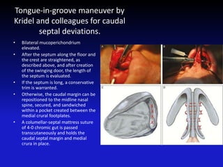 Tongue-in-groove maneuver by
Kridel and colleagues for caudal
septal deviations.
• Bilateral mucoperichondrium
elevated.
• After the septum along the floor and
the crest are straightened, as
described above, and after creation
of the swinging door, the length of
the septum is evaluated.
• If the septum is long, a conservative
trim is warranted.
• Otherwise, the caudal margin can be
repositioned to the midline nasal
spine, secured, and sandwiched
within a pocket created between the
medial crural footplates.
• A columellar-septal mattress suture
of 4-0 chromic gut is passed
transcutaneously and holds the
caudal septal margin and medial
crura in place.
 