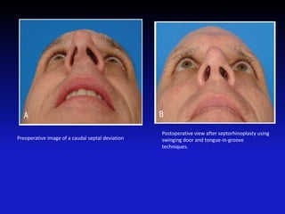 Preoperative image of a caudal septal deviation
Postoperative view after septorhinoplasty using
swinging door and tongue-in-groove
techniques.
 