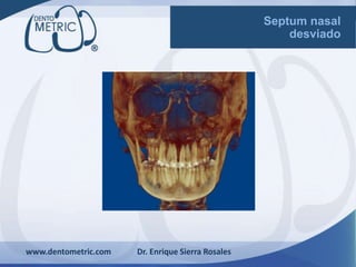 www.dentometric.com Dr. Enrique Sierra Rosales
Septum nasal
desviado
 