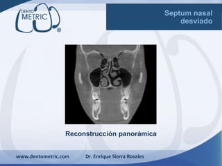 Reconstrucción panorámica
www.dentometric.com Dr. Enrique Sierra Rosales
Septum nasal
desviado
 