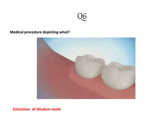 Q6
Medical procedure depicting what?
Extraction of Wisdom tooth
 