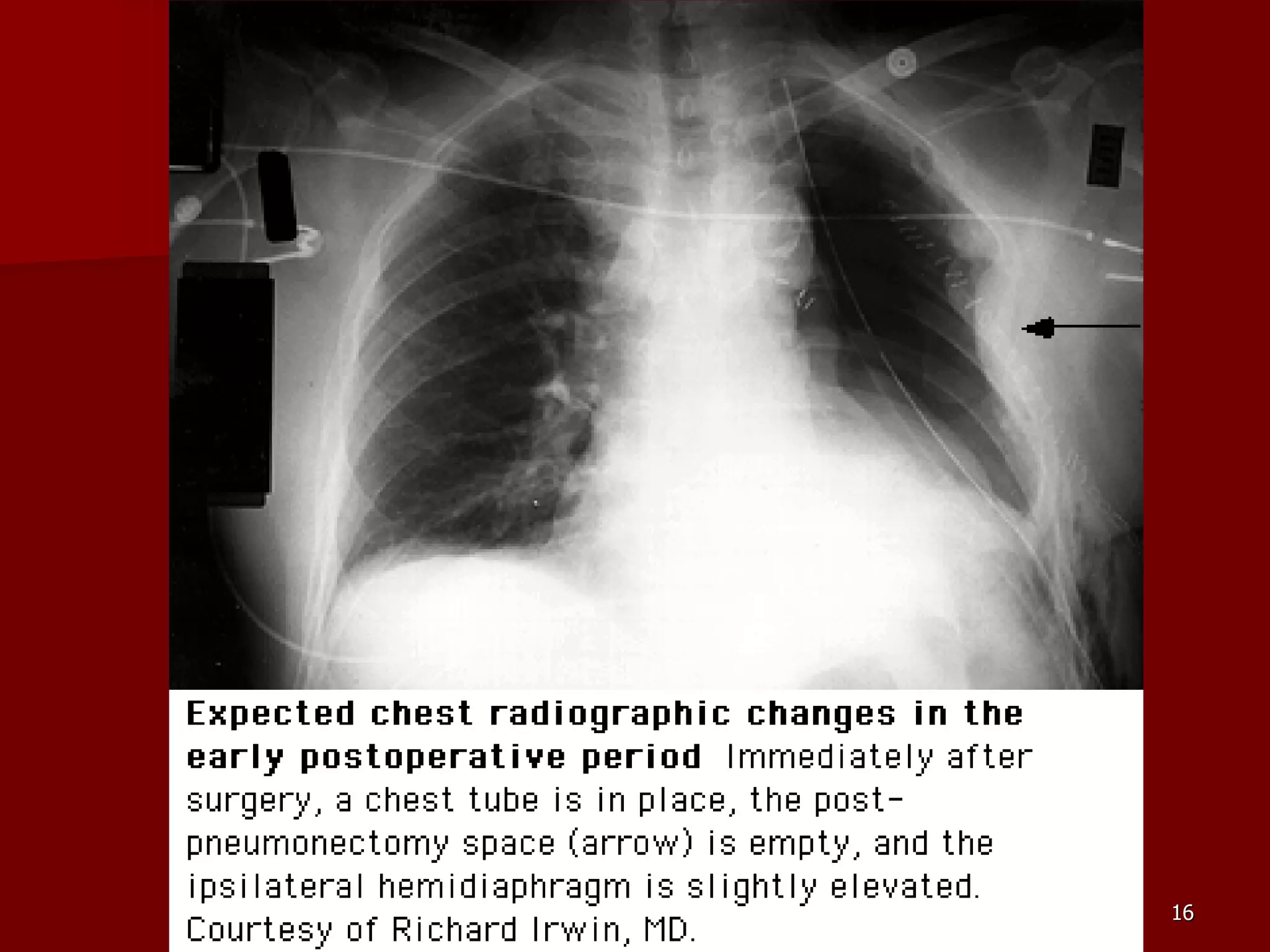 Sequelae & Complications of Pneumonectomy | PPT