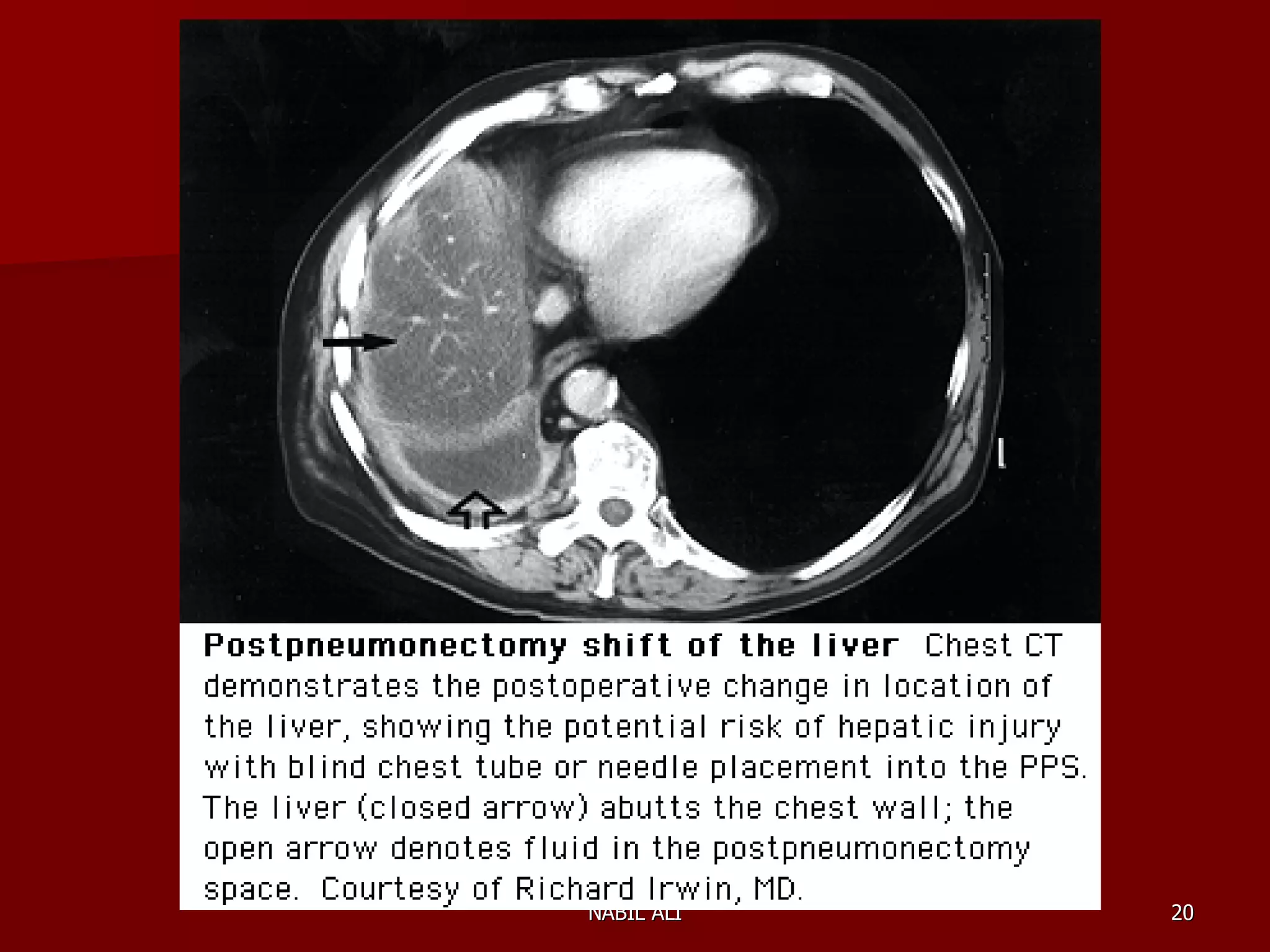 Sequelae & Complications of Pneumonectomy | PPT