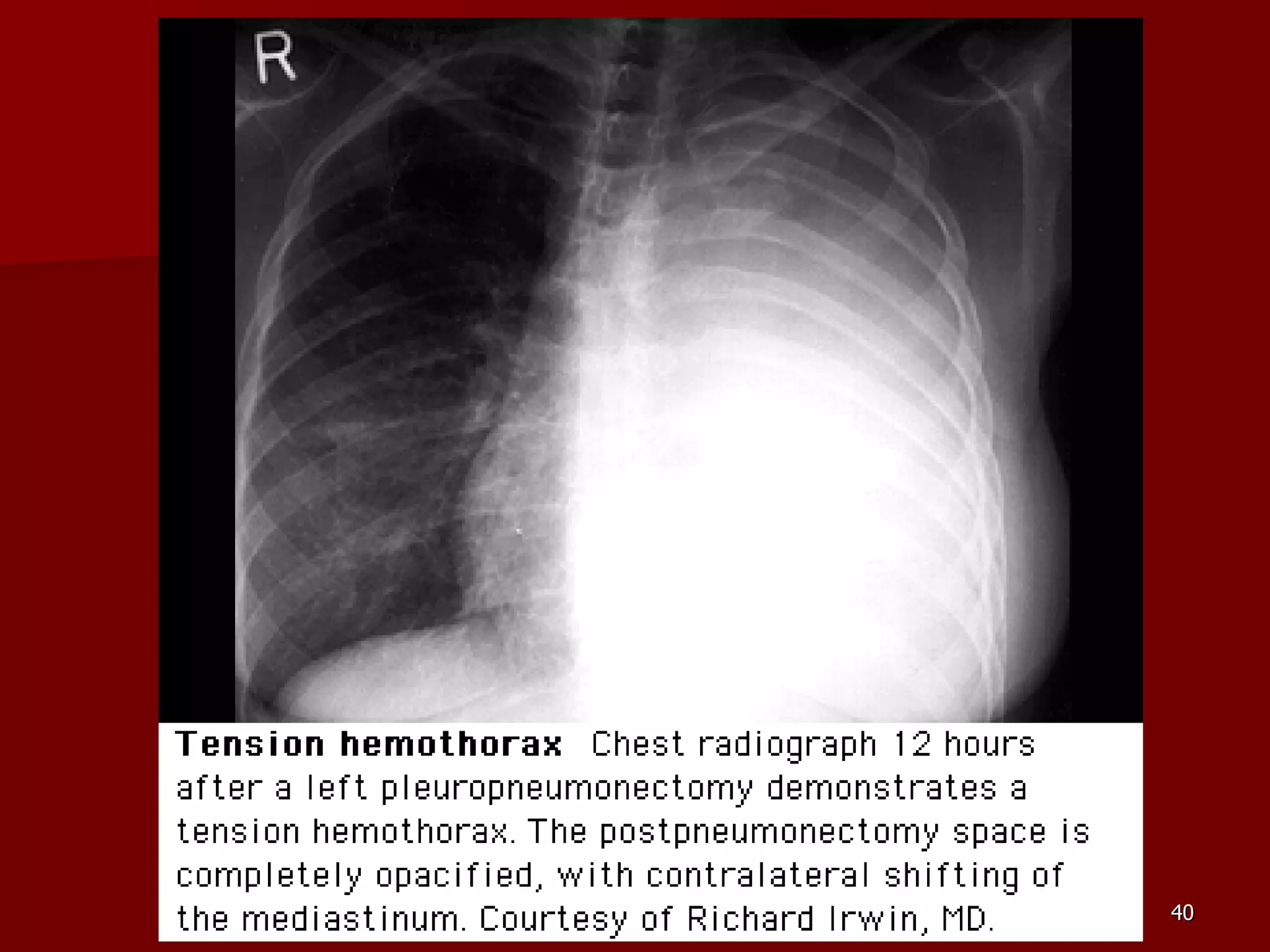 Sequelae & Complications of Pneumonectomy | PPT