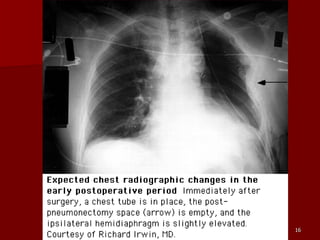 Sequelae & Complications of Pneumonectomy | PPT