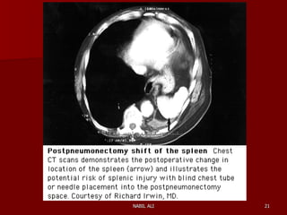 Sequelae & Complications of Pneumonectomy | PPT