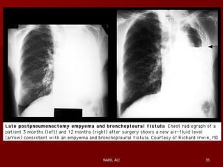 Sequelae & Complications of Pneumonectomy | PPT