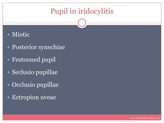 Pupil in iridocylitis


 Miotic

 Posterior synechiae

 Festooned pupil

 Seclusio pupillae

 Occlusio pupillae

 Ec...