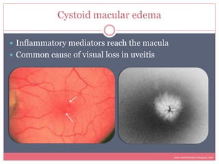 Cystoid macular edema

 Inflammatory mediators reach the macula
 Common cause of visual loss in uveitis




            ...