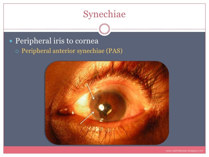 sequelae complications of uveitis 10 728