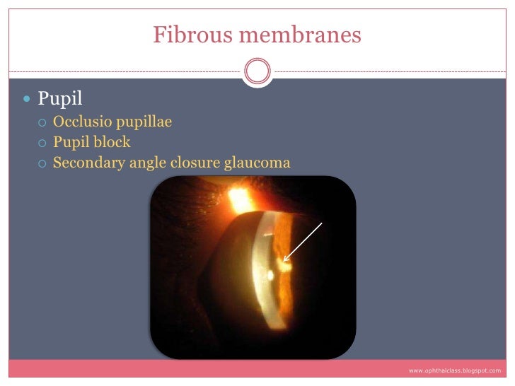 Sequelae & Complications of Uveitis