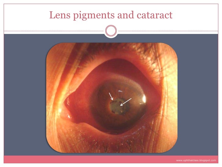 Sequelae & Complications of Uveitis