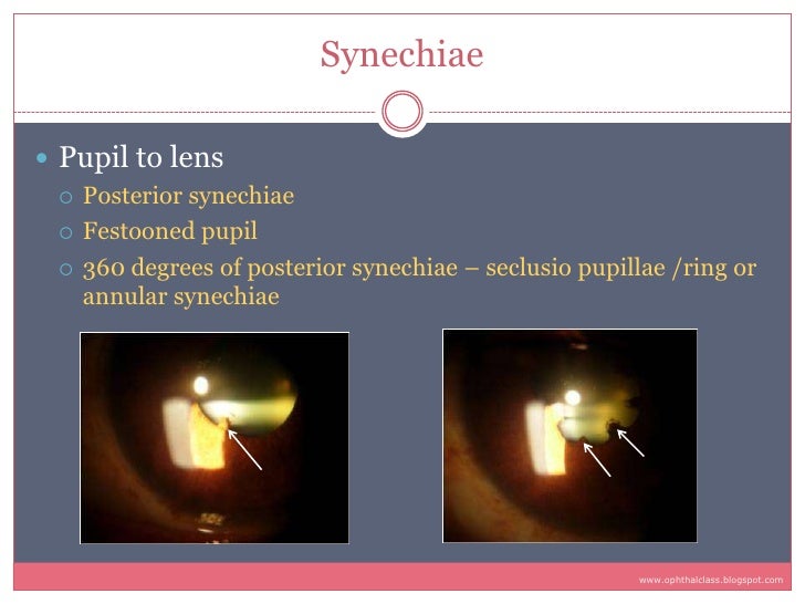 Sequelae & Complications of Uveitis