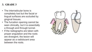 Interradicular Inection Sequelae of periodontal diseases | PPTX